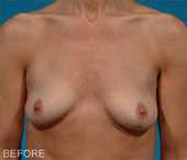 Patient # 51921 Before Photo # 1